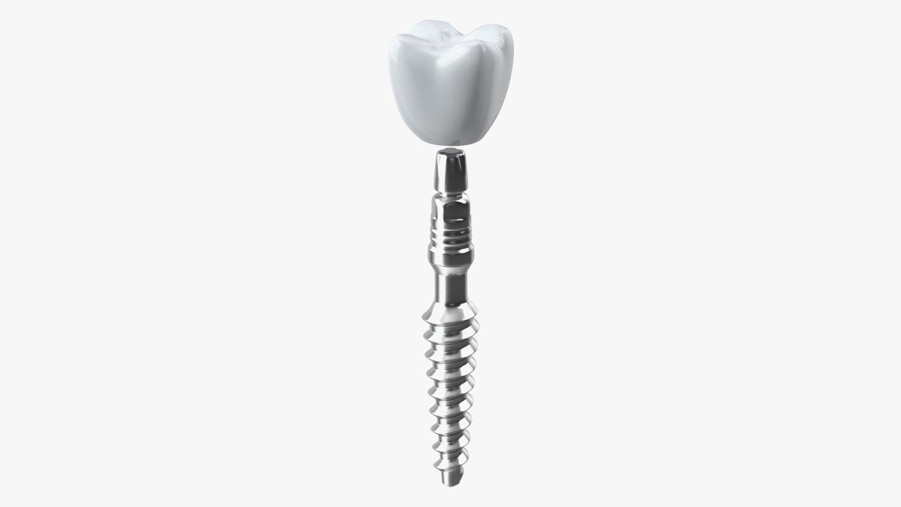 Advances in Biomaterials for Dental Implants: From Nanotechnology to ...