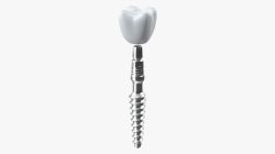 Advances in Biomaterials for Dental Implants: From Nanotechnology to ...